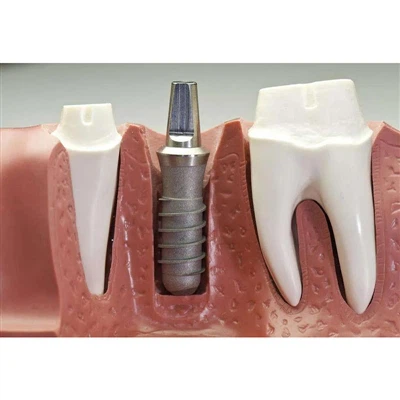 Odemknutí záhady: Jak rozhraní spojení implantát-abutment ovlivňuje stabilitu...